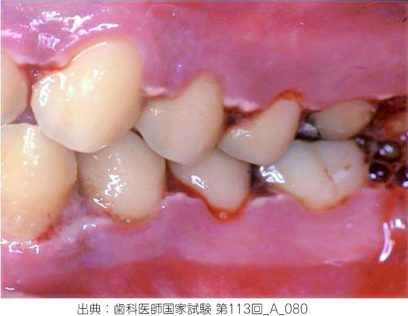 歯茎 の 潰瘍