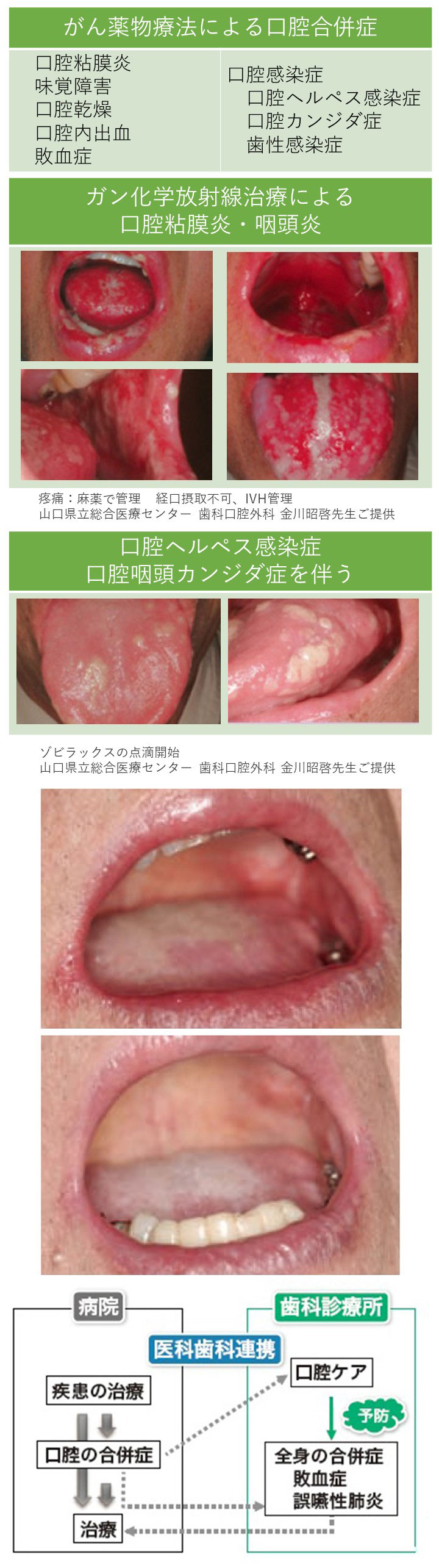 ３１　ガン治療における口腔合併症