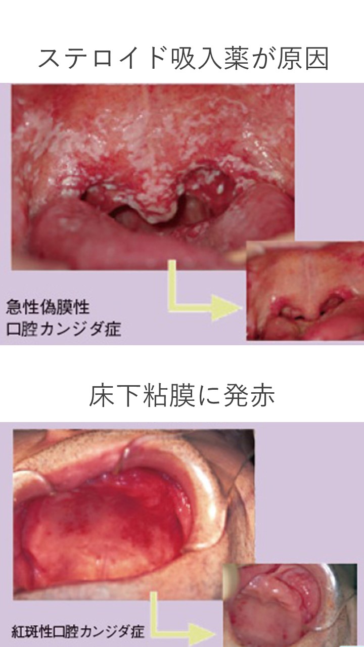 ２１　ステロイド吸入薬とカンジダ症