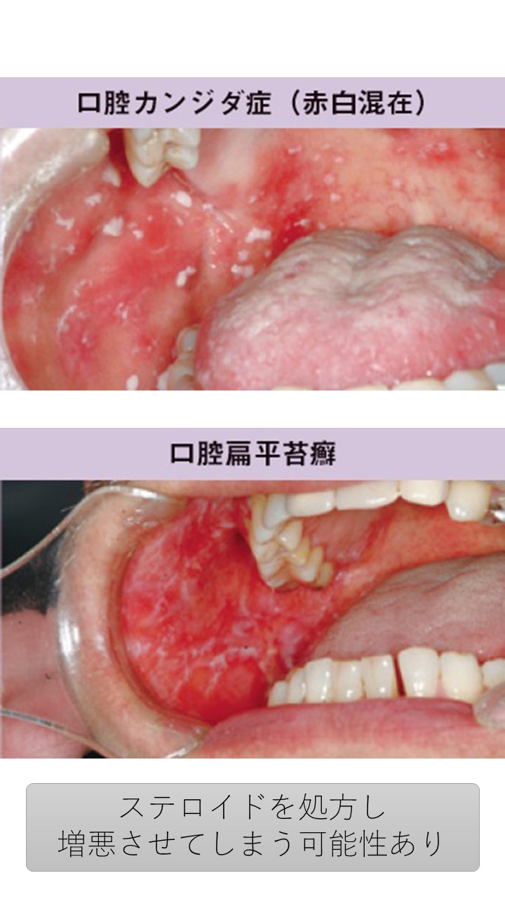 ２０　扁平苔癬と口腔カンジダ症