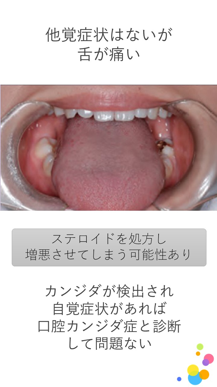 １９　舌痛とカンジダ症