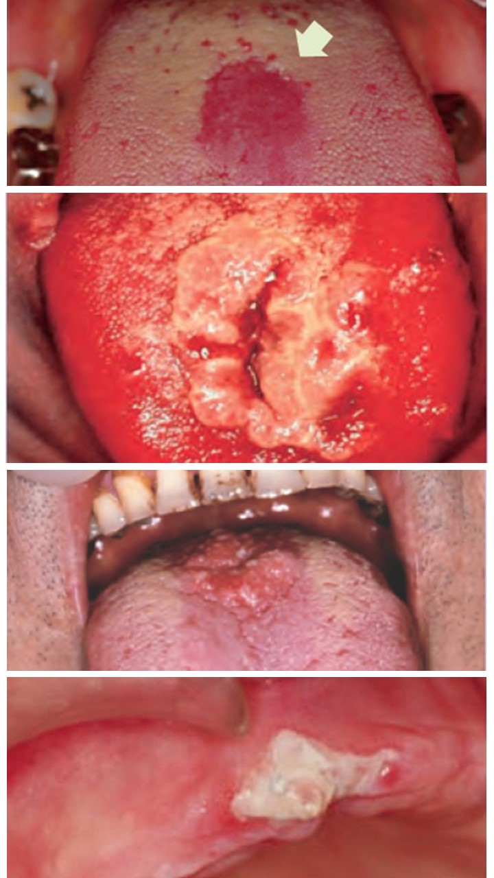 １７　肥厚性口腔カンジダ症