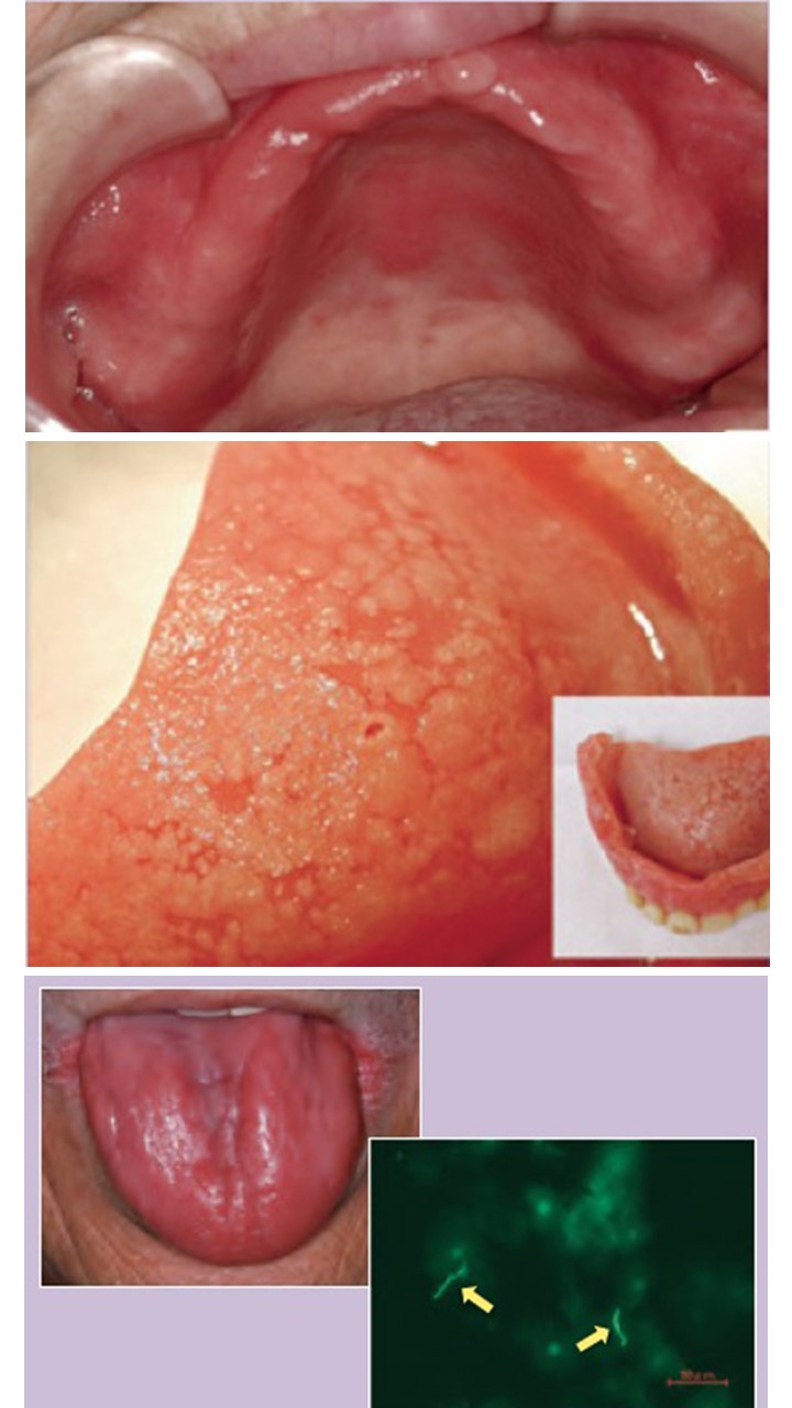 １６　慢性萎縮性（紅斑性）口腔カンジダ症