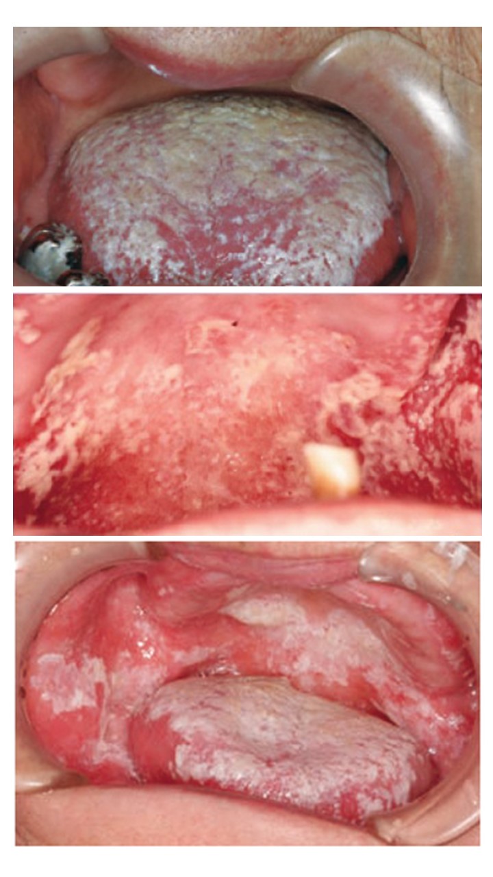 １５　急性偽膜性口腔カンジダ症