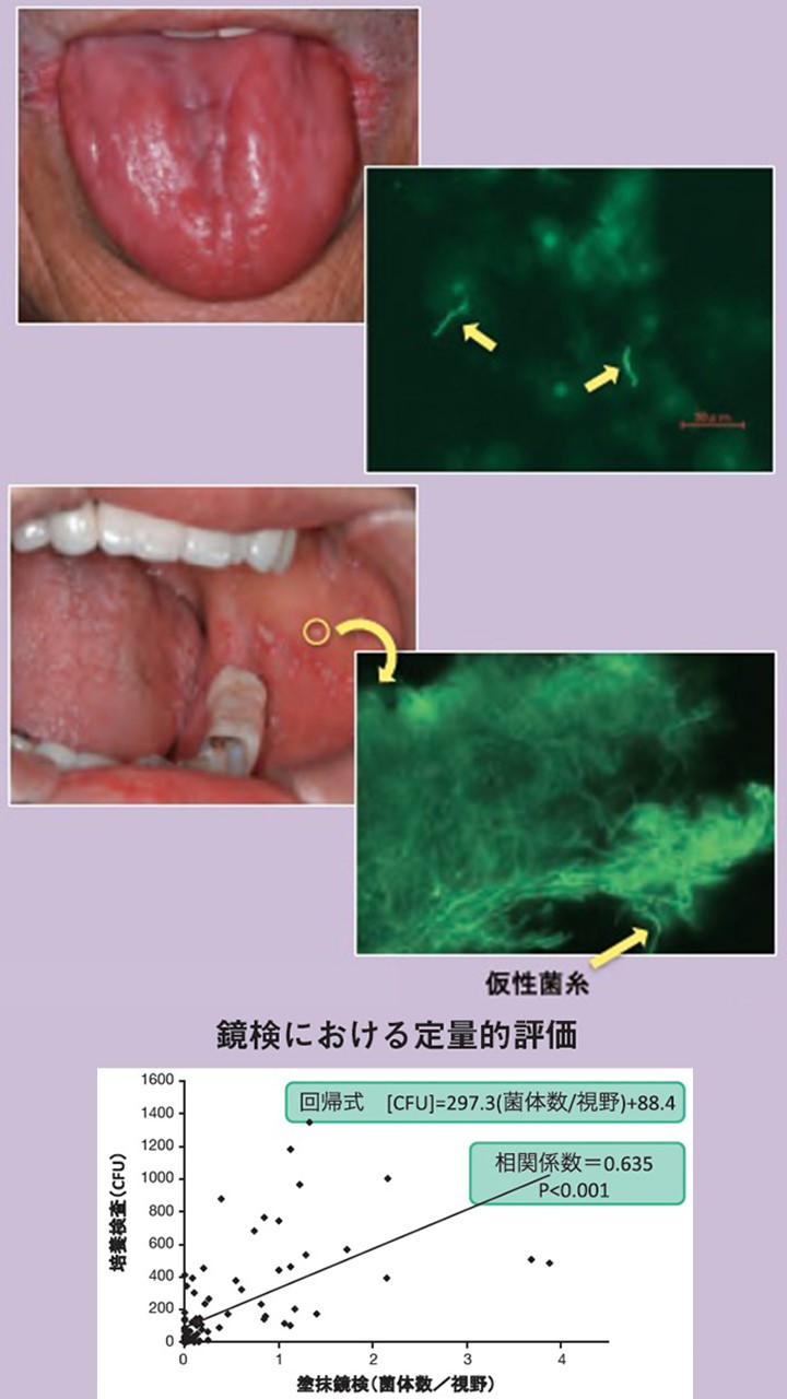 １０　口腔カンジダ症 鏡検による確定診断