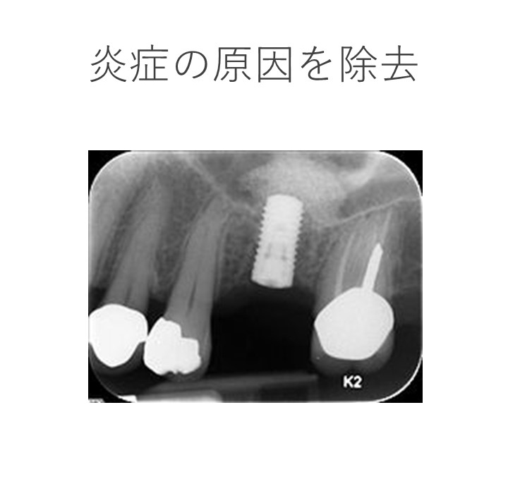 インプラント周囲粘膜炎（可逆性炎症）への対処法は？