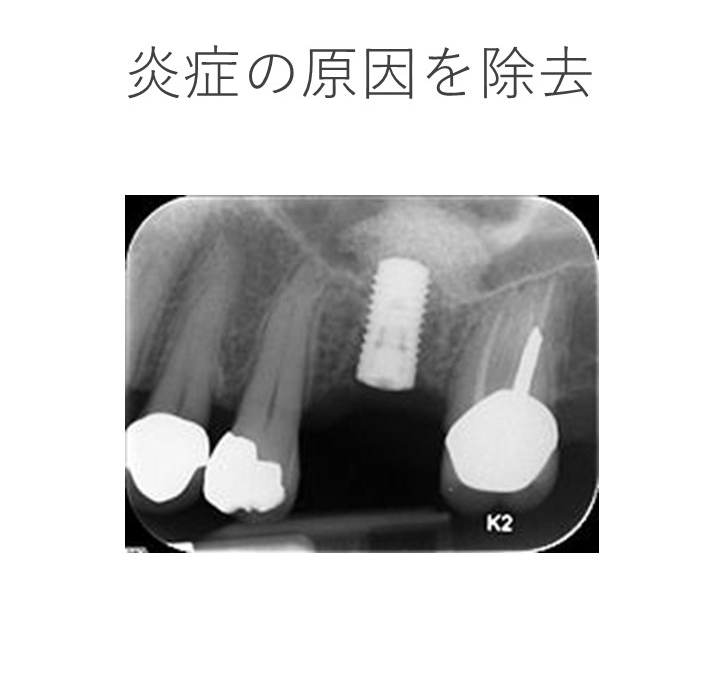 インプラント周囲炎（不可逆性炎症）への対処法は？