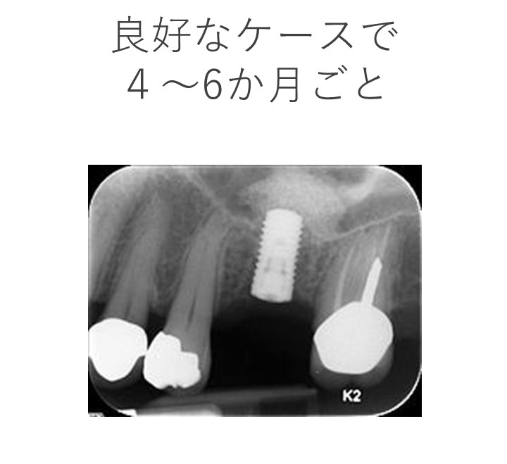 インプラントのメンテナンス間隔は？