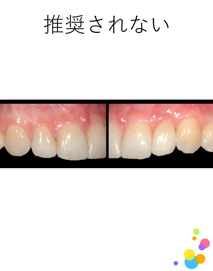 支台歯に動揺のある症例に対して，接着ブリッジの適用は推奨されますか？