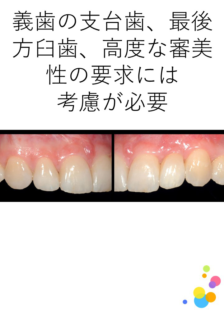 CAD/CAM冠の考慮すべき症例を教えてください。