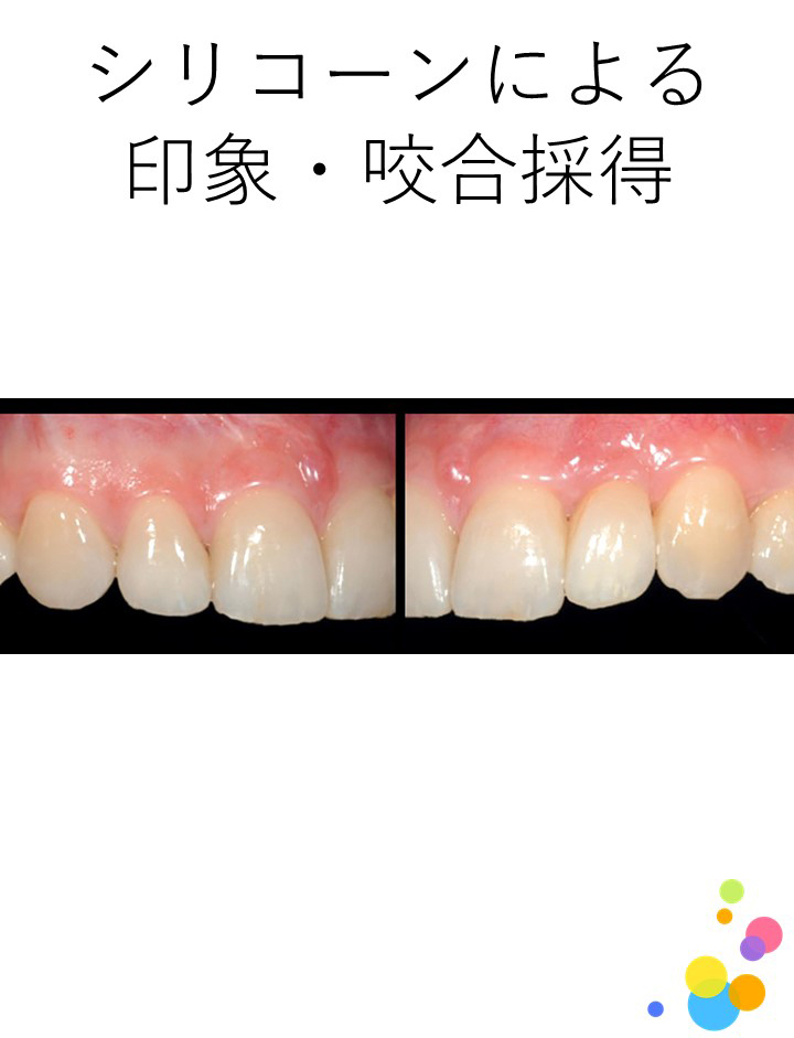 CAD/CAM冠の印象・咬合採得には何を使用すればよいのですか？