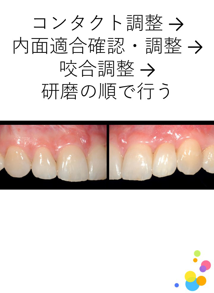 CAD/CAM冠の調整・研磨の流れについて教えてください。