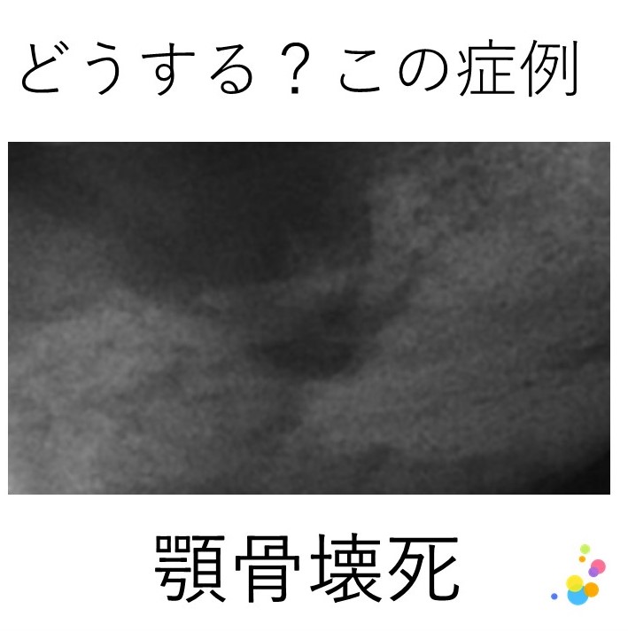 薬剤関連顎骨壊死への対応