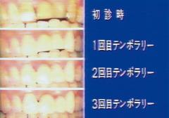ステップアップテンポラリー