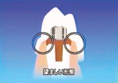 次世代へ拡がる　磁性アタッチメントの世界