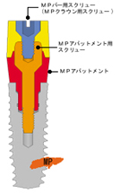 MPアバットメント