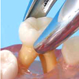 複製根乳歯模型歯 [B4-309]