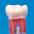 歯髄切断用乳歯模型歯 [A24A-204]