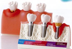 インプラント周囲病変模型