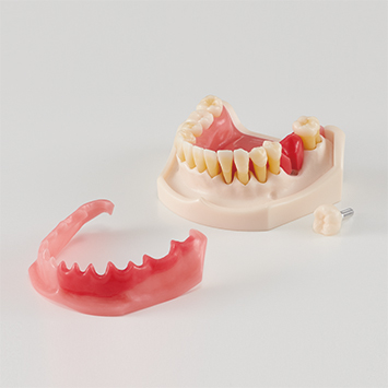 歯周病･インプラント周囲炎説明用模型
【PE-PER015】